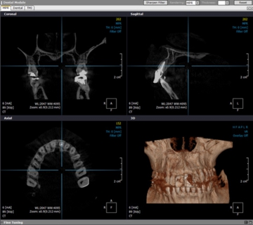 デジタルレントゲン、歯科用CT